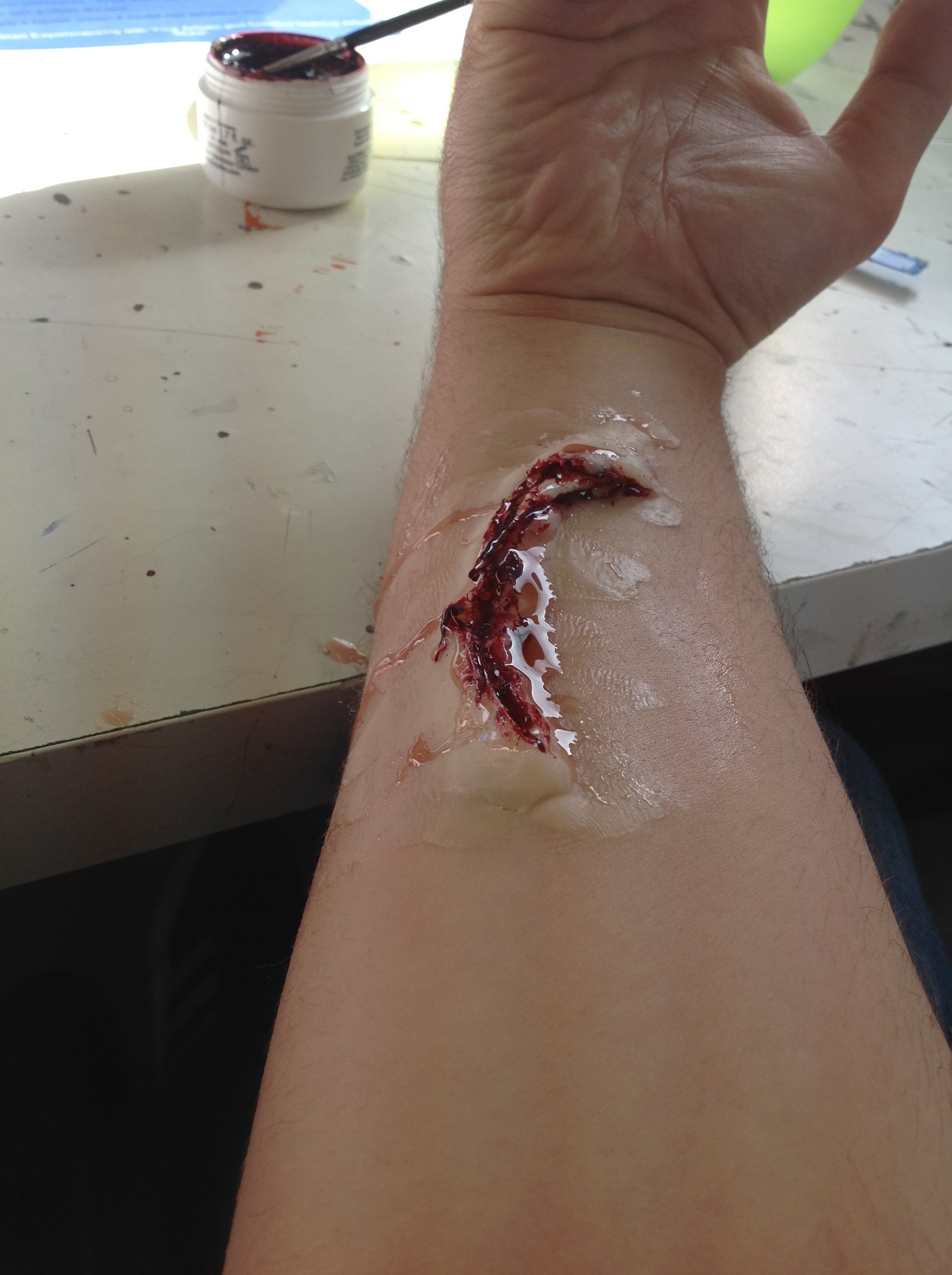 Wound with exposed bone