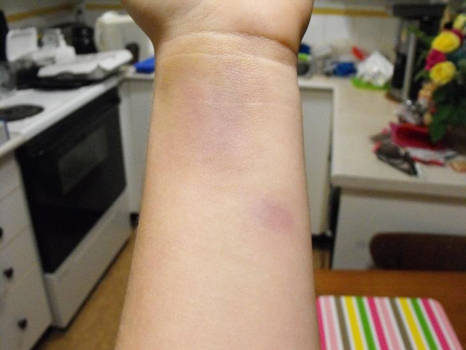 Wrist Bruise