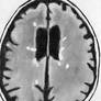 Multiple Sclerosis MRI