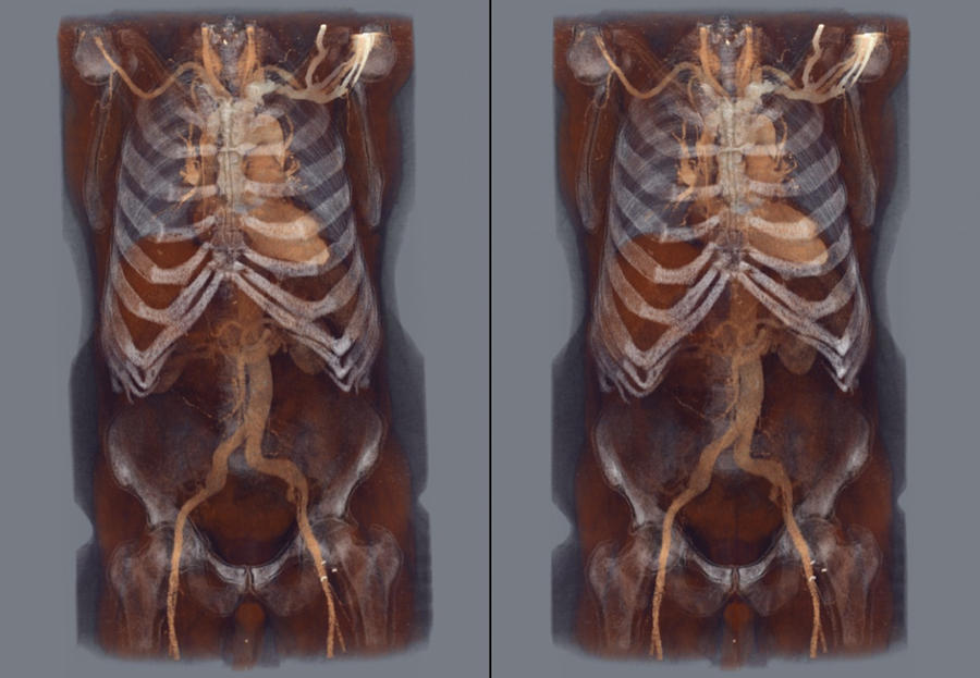 Aortic Dissection 5 by voxel123 on DeviantArt