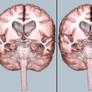 Alzheimer's Disease 1c