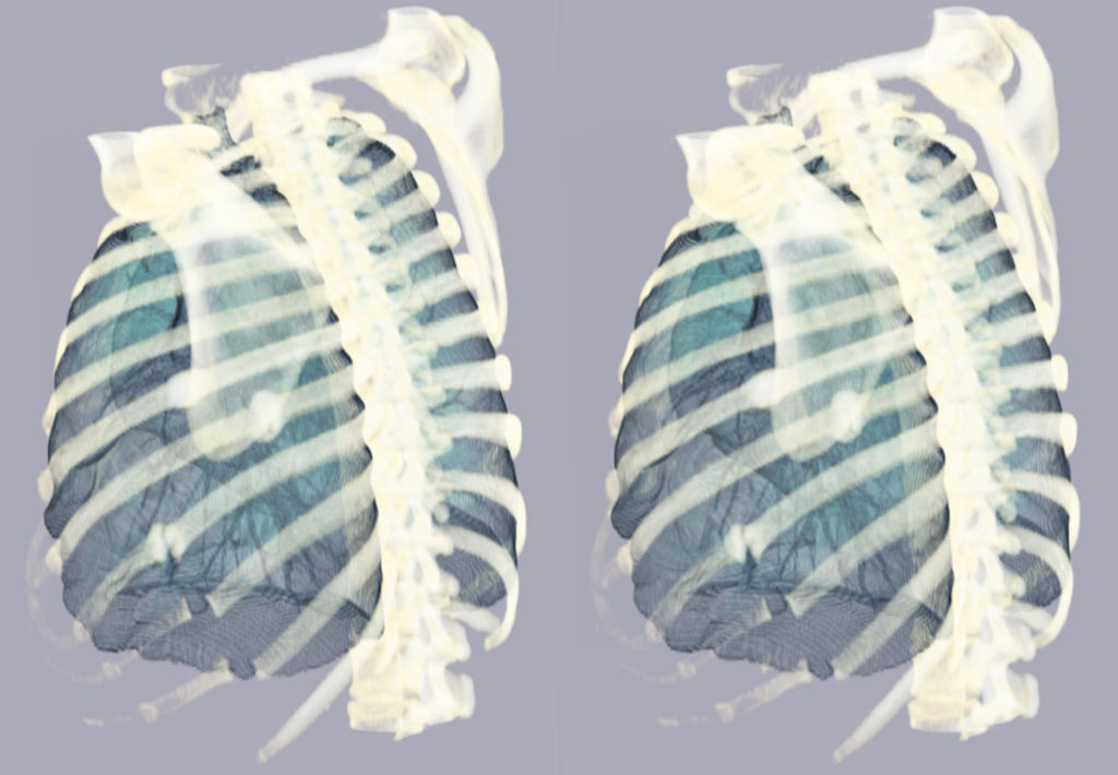 Serial Rib Fracture 1c by voxel123 on DeviantArt