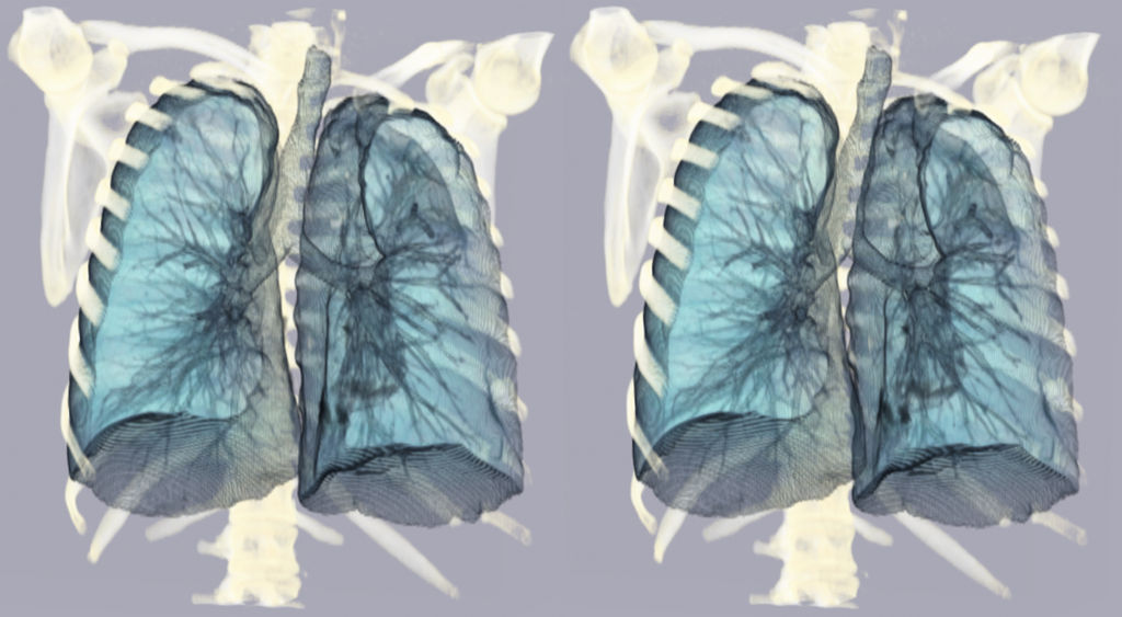 Serial Rib Fracture 1d by voxel123 on DeviantArt