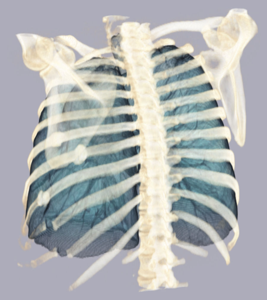Serial Rib Fracture 1 by voxel123 on DeviantArt