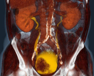 Bladder Carcinoma 1.1 by voxel123