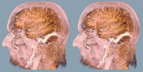 Meningeoma 1d