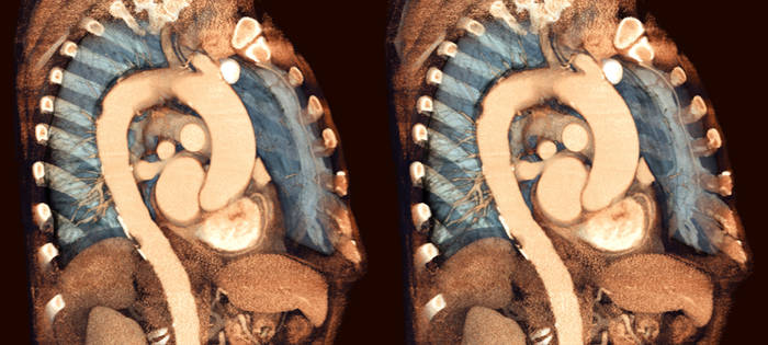 Thoracic Angiography 3d