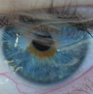 my eye again