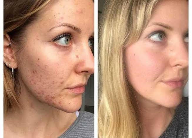 Acne Filter Effect Treating the effects of acne by salifcisse on DeviantArt