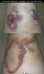 Reference - Aging Bruises by Leonca
