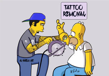 Homers tattoo removal