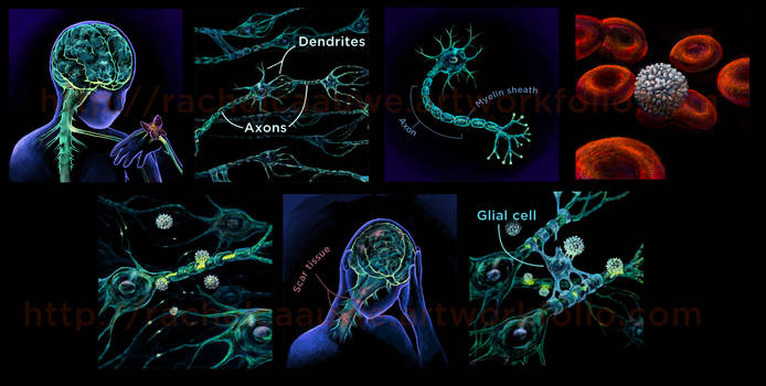 Multiple Sclerosis - medical illustration