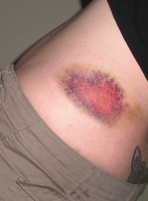 Bruise