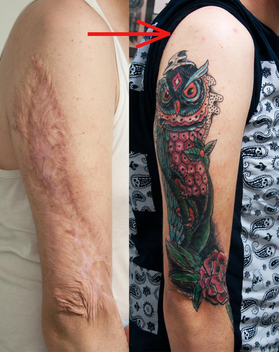 burn scar cover (healed)