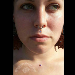 Healed philtrum and fresh surface anchor.