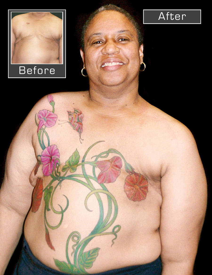 Mastectomy cover-up.