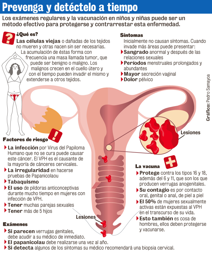 Cancer de cervix