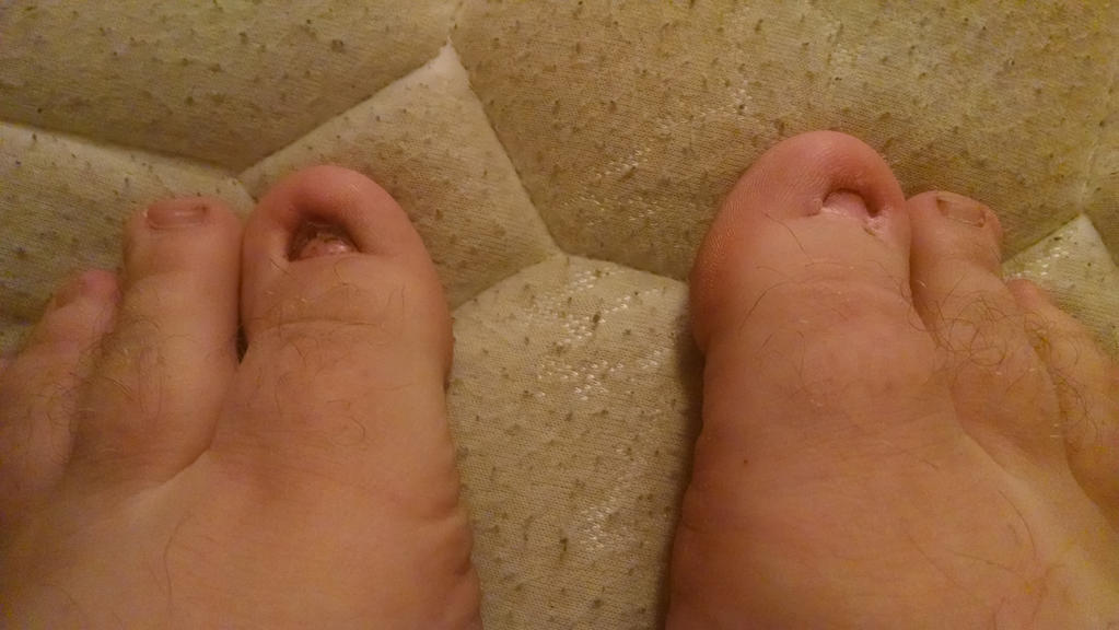 Possible Treatments for a Big Toe Nail That is Changing Color and Falling Off - wide 4