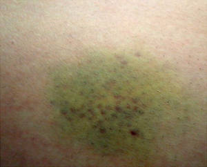 Epic Bruise!