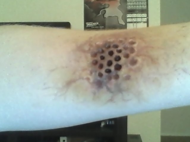 Trypophobia