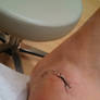 12 02 13 Stitches Out