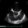 My pulmonary valve - SUPER CUTE