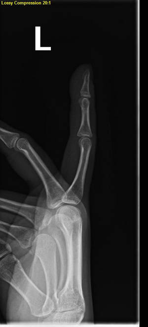 Left Hand X-Ray Stock III