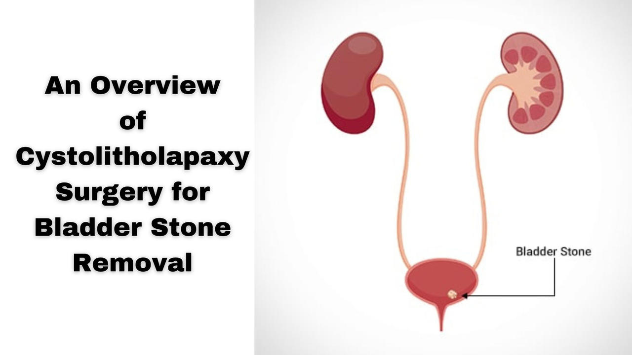 An Overview Of Cystolitholapaxy Surgery For Bladde By Delhiurology On an-overview-of-cystolitholapaxy-surgery-for-bladde-by-delhiurology-on