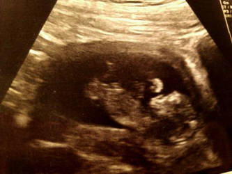 12 week ultrasound