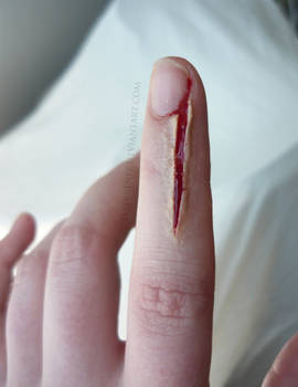 Pesky Hangnail.