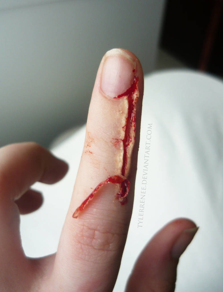 Pesky Hangnail II.