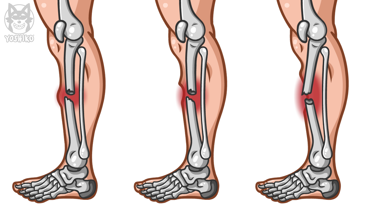 Fractured Example Cartoon Bone Fracture Drawing by Yoshiko-Animation on DeviantArt