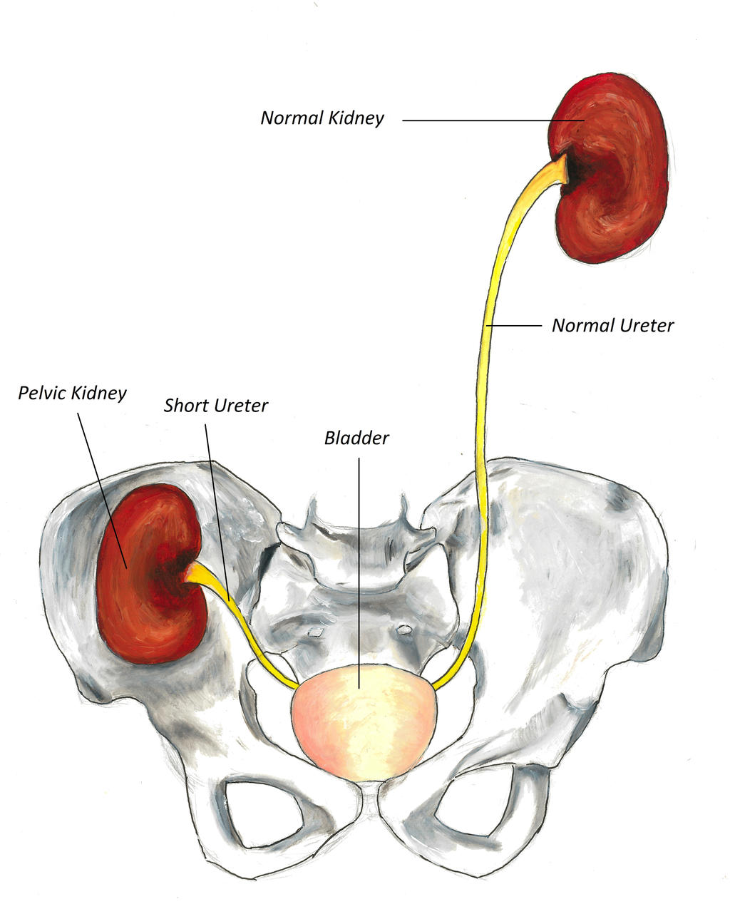 7. Pelvic kidney labelled by DocSleepless on DeviantArt
