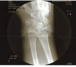 Broken wrist x-ray one by Vincent-Nocturnal