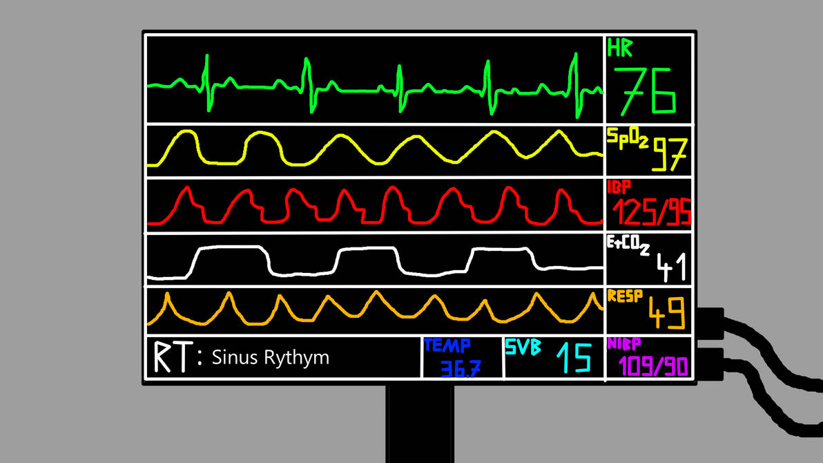 Sinus Rythym Display Sinus Rythym (Remake) by Tavukskini on DeviantArt