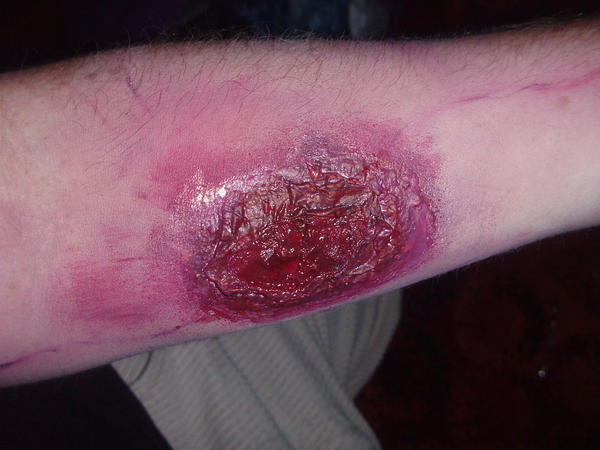 Arm wound