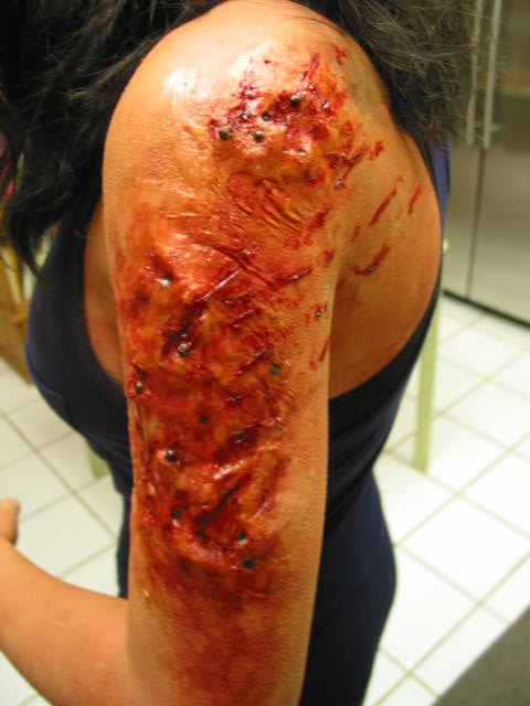 Shotgun arm wound