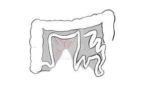 Studer neoblader - Phase 1 - Cutting the ileum