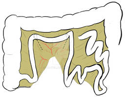 Studer neobladder - Phase 1 - Cutting the ileum - 