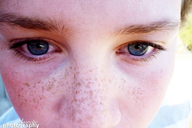 freckles