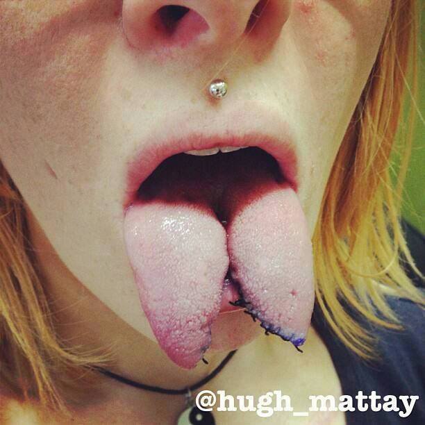 Tongue healing split Tongue Fissures: