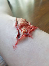 Upper Arm Laceration