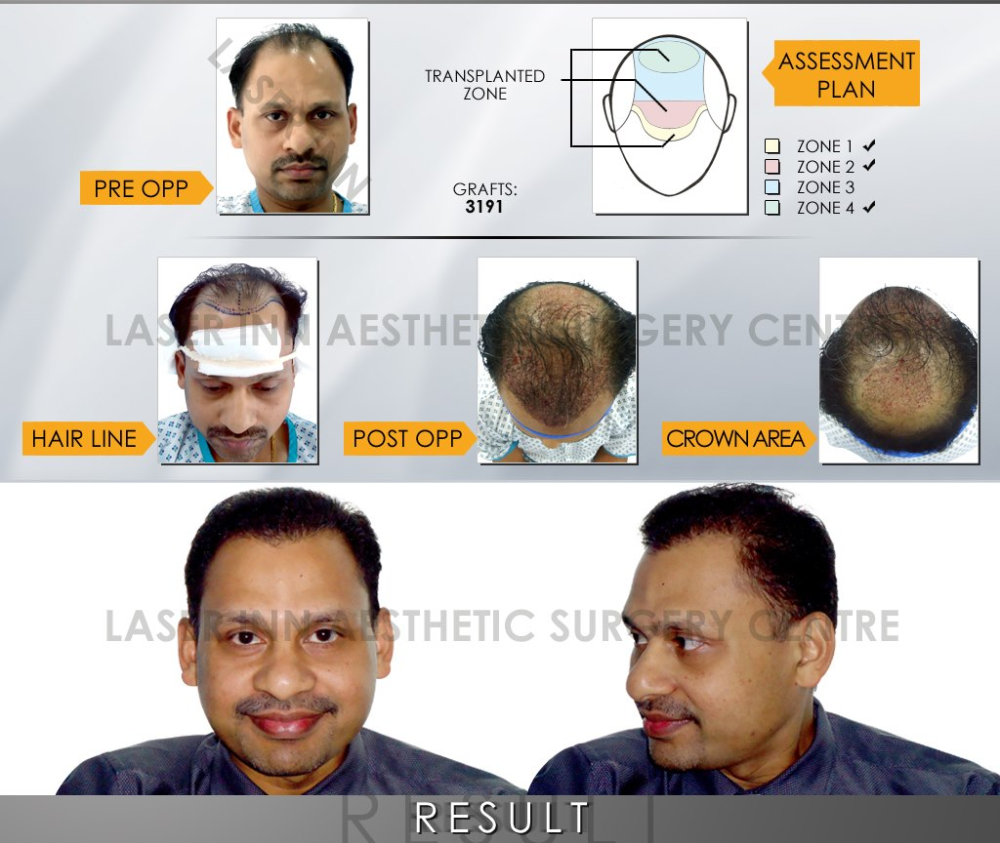 FUE Result of Dr. Parsad by Tunio Hair Transplant by DrTunio on DeviantArt FUE Result of Dr. Parsad by Tunio Hair Transplant by DrTunio on DeviantArt