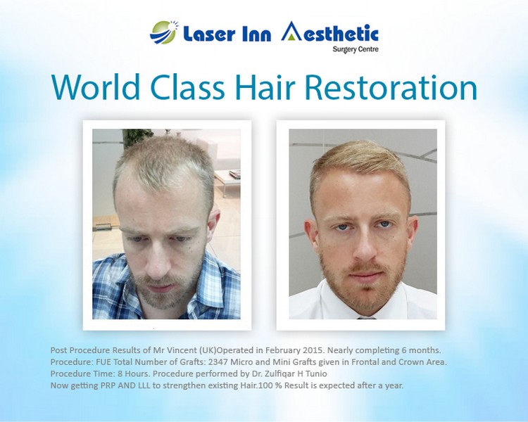 World Class Hair Transplant Centre in Pakistan by DrTunio on DeviantArt World Class Hair Transplant Centre in Pakistan by DrTunio on DeviantArt