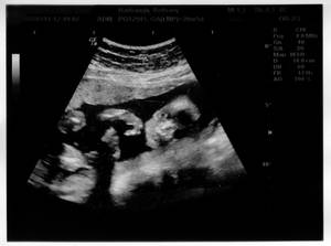 Baby Harbaugh Ultrasound