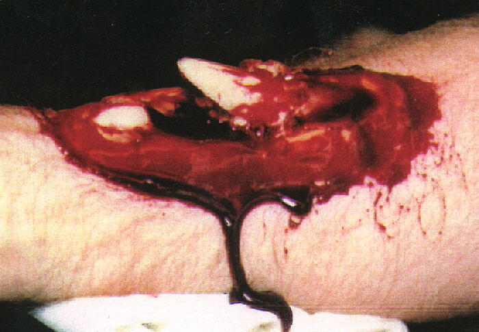 Compound Fracture By Bloodstorme On Deviantart