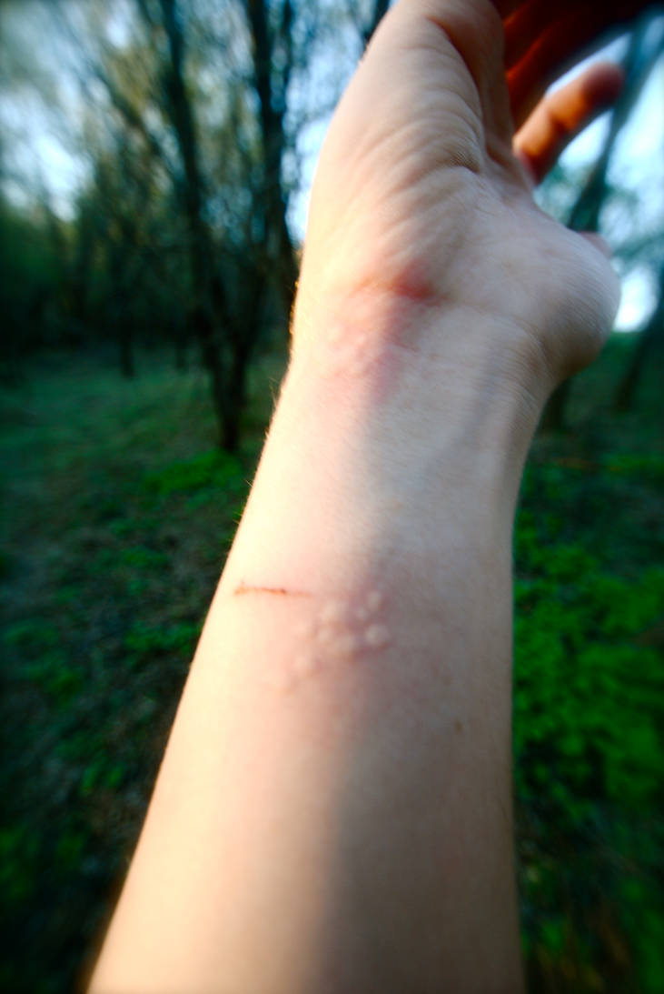 What Is A Nettle Rash at Gemma Dalton blog