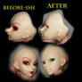 Shiwoo rhinoplasty