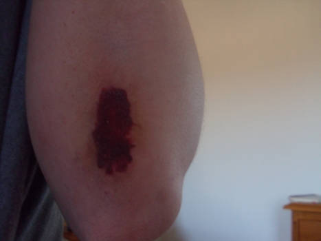 skinned elbow