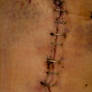 stitches staples 2